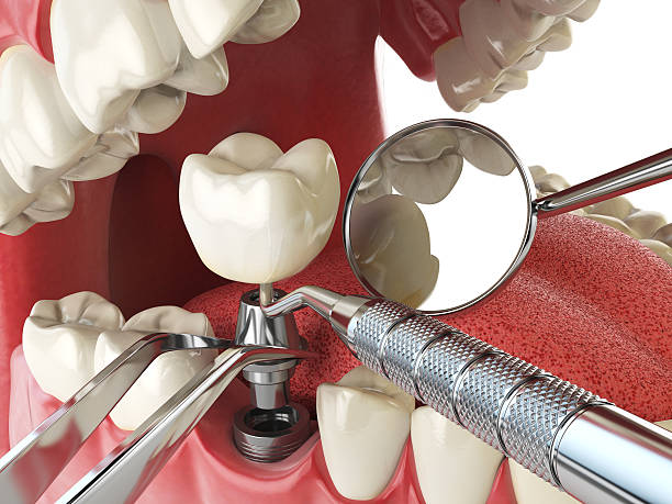 Best Emergency Dentist for Lost Fillings or Crowns in On Top Of The World Designated Place, FL